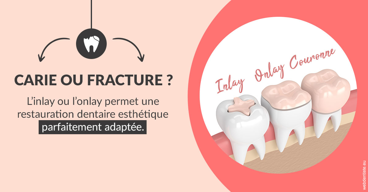 https://selarl-couchat-et-associes.chirurgiens-dentistes.fr/T2 2023 - Carie ou fracture 2
