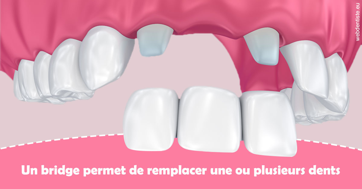 https://selarl-couchat-et-associes.chirurgiens-dentistes.fr/Bridge remplacer dents 2