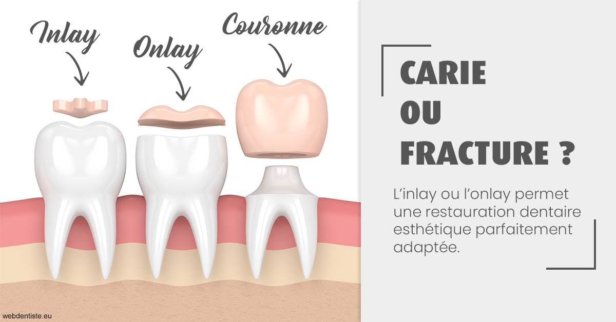 https://selarl-couchat-et-associes.chirurgiens-dentistes.fr/T2 2023 - Carie ou fracture 1