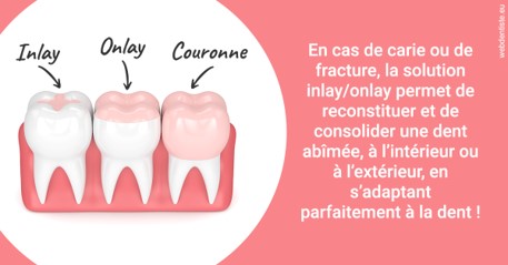 https://selarl-couchat-et-associes.chirurgiens-dentistes.fr/L'INLAY ou l'ONLAY 2