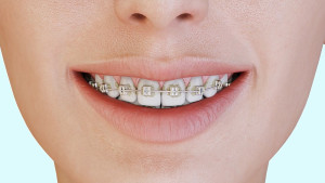 Nettoyage des brackets avec brossette interdentaire